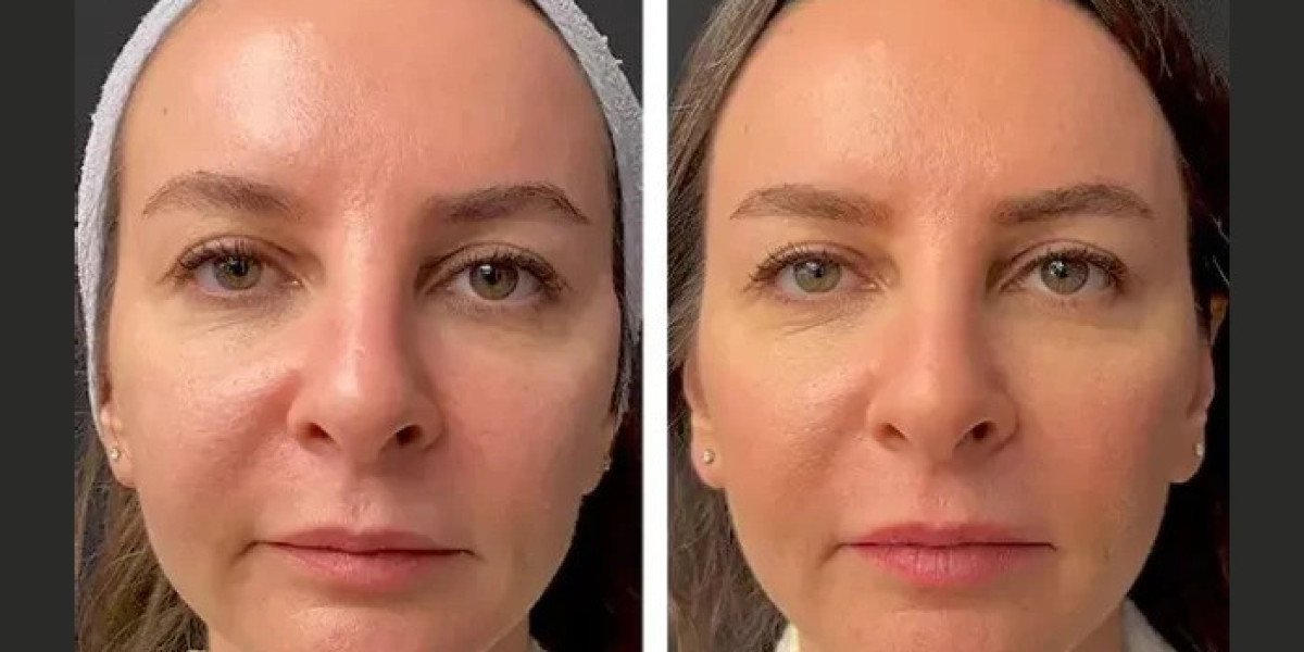 Best Aesthetic Clinic in dubai for Mesotherapy Benefits and Uses